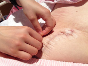 卵巣癌 開腹手術 傷口