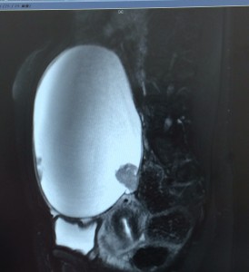 卵巣癌MRI